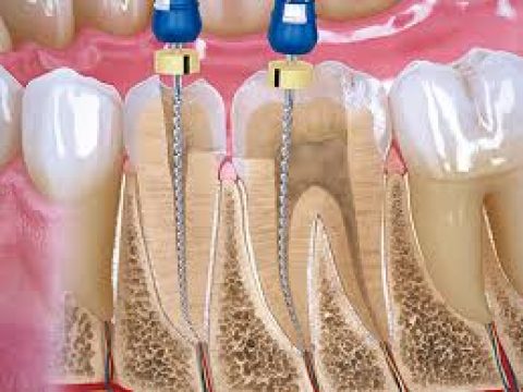 endodoncia