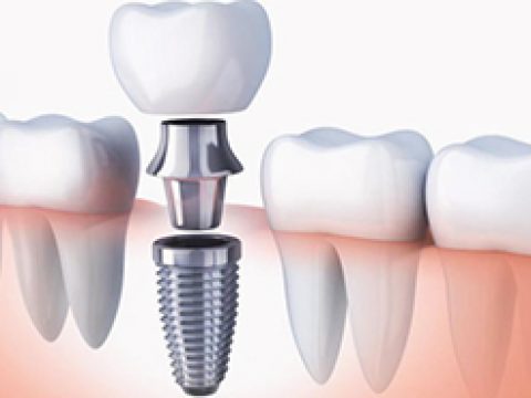 implante-dental